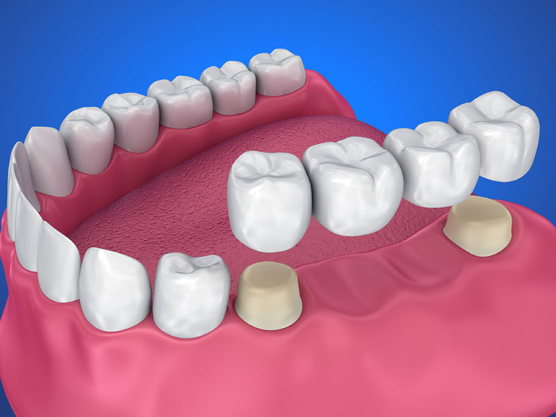 dental bridges near you