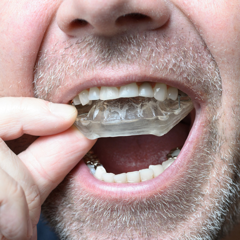 mouth guards in lethbridge