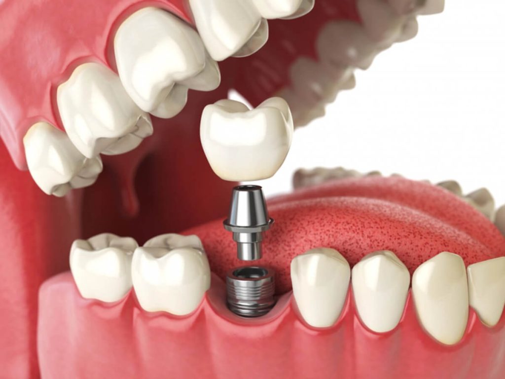 a fixed replacement for missing teeth dental implants