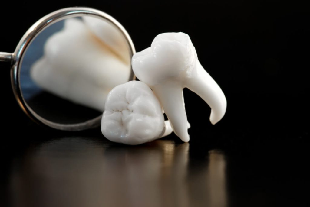 why should you remove your wisdom teeth