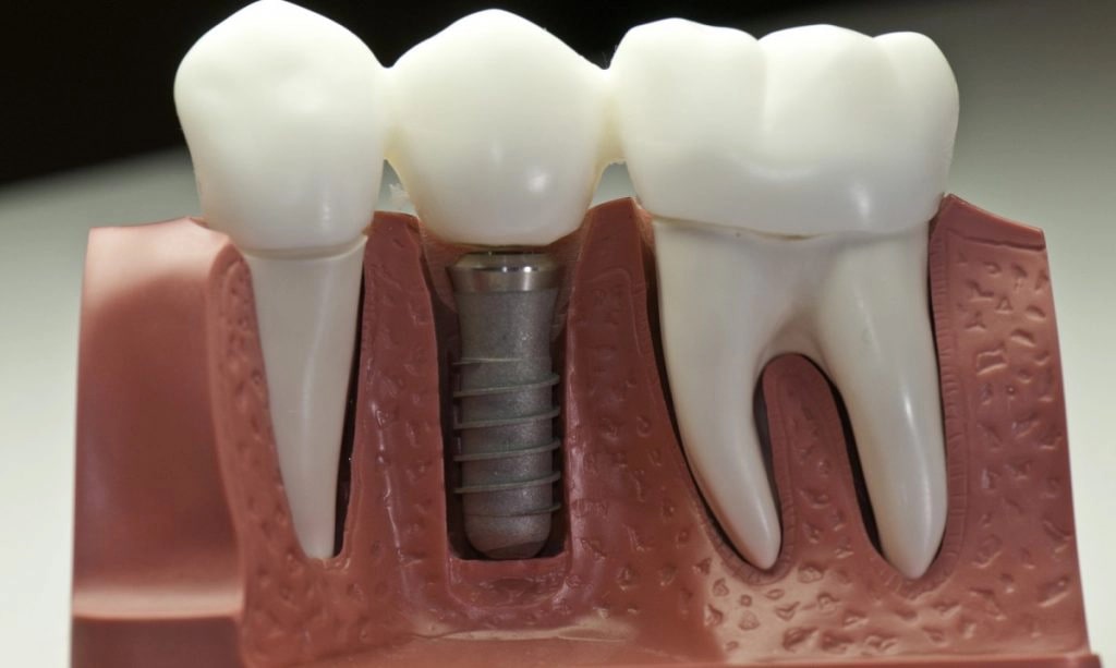 great reasons to choose dental implants