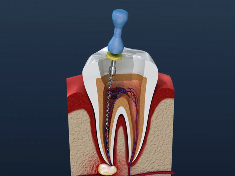 root canal therapy near you