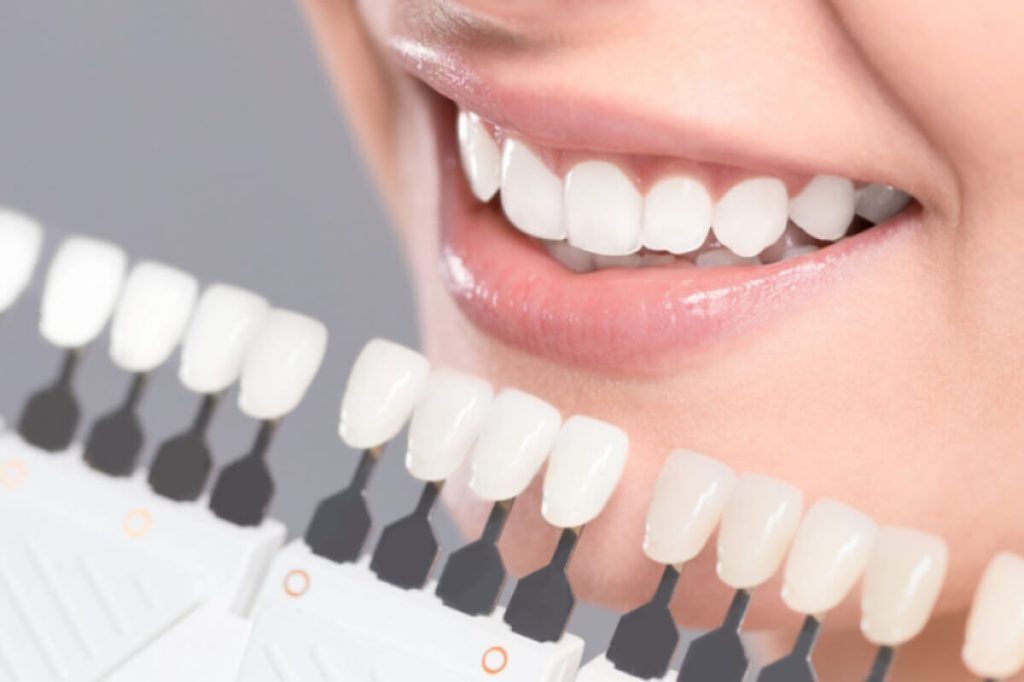 ways dental veneers can improve your smile