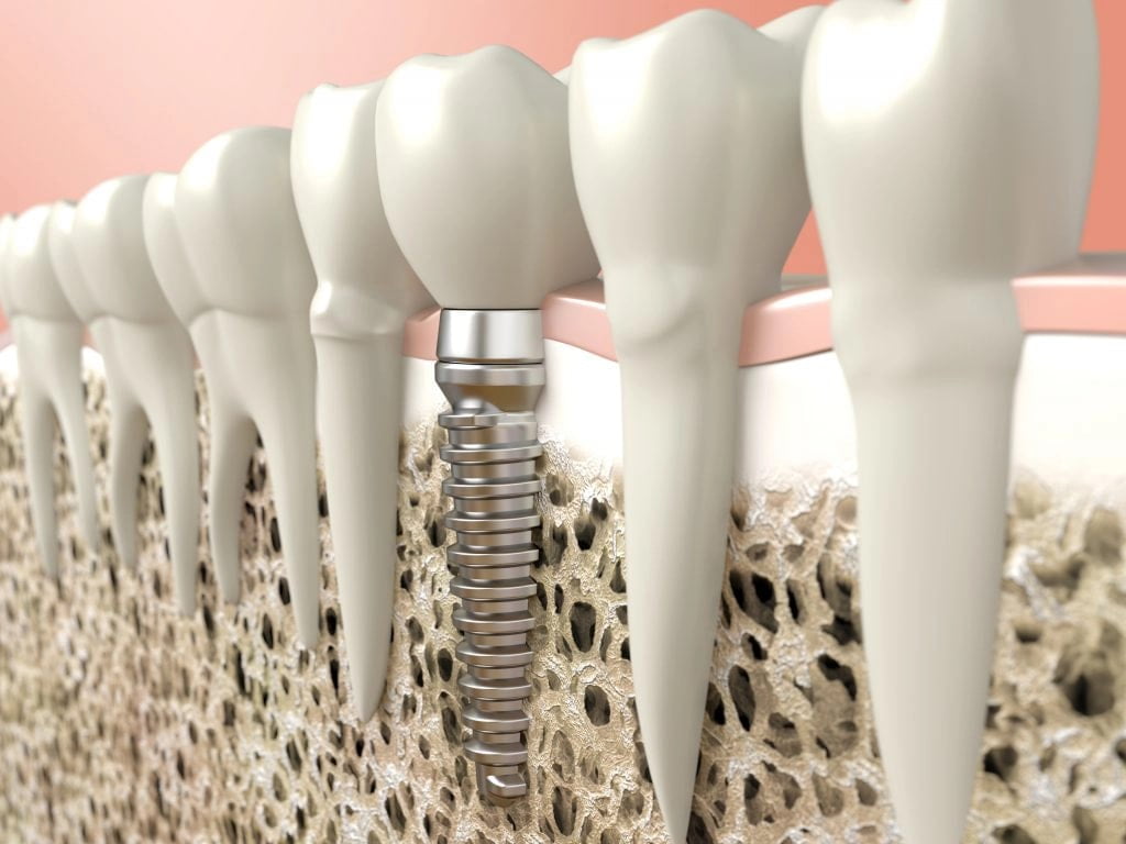 what goes into the cost of dental implants