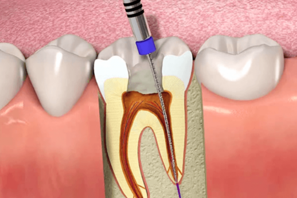 difference between root canal and a filling