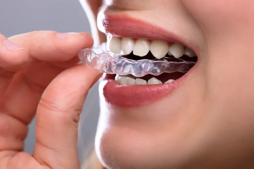 how clear aligners work and who they are for