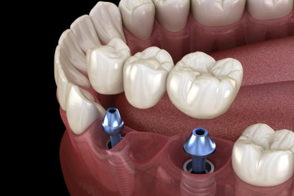 how soon you can eat food after dental bridges