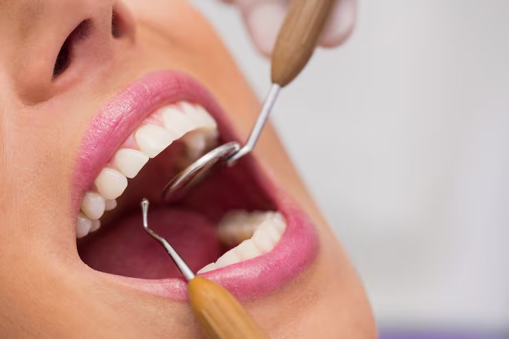 What is dental bonding and how does it improve your smile